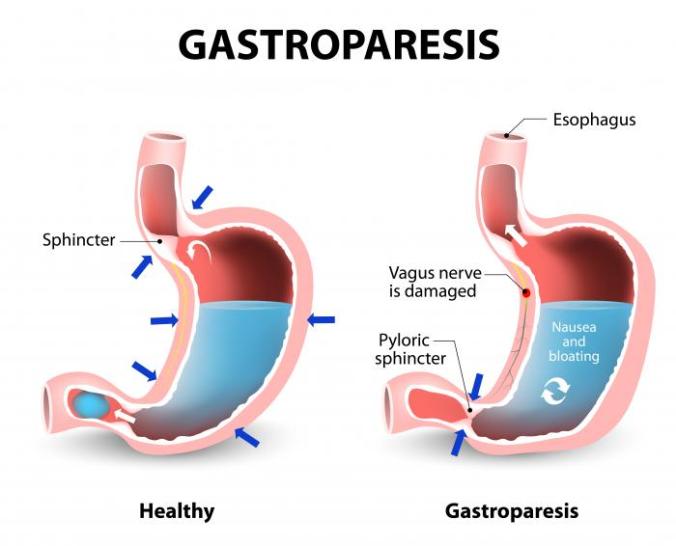 a-diagram-showing-two-stomachs-representing-the-effects-of-gastroparesis